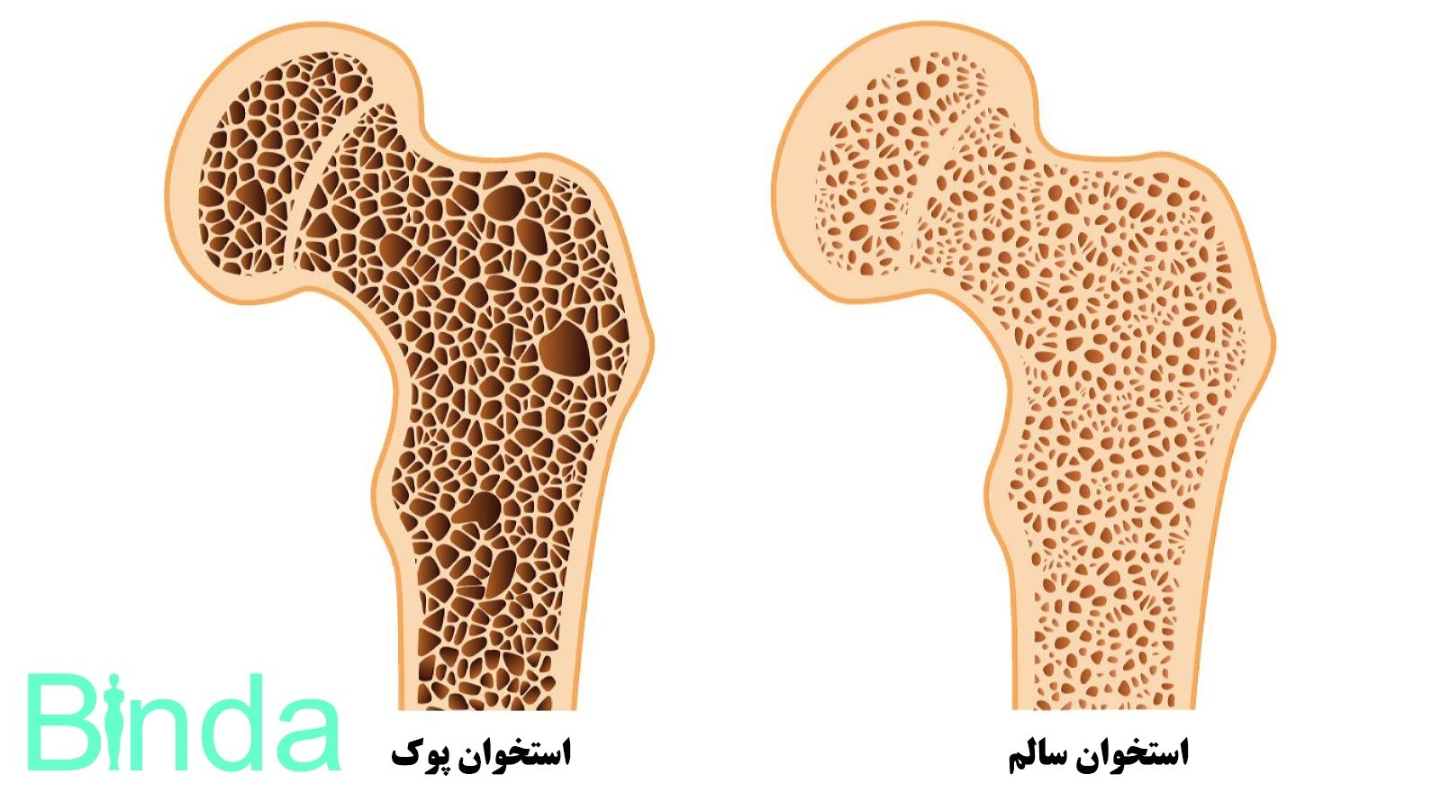 همه‌چیز درباره پوکی استخوان